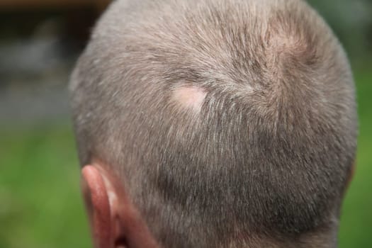 Man with circular hair loss at the back of the head