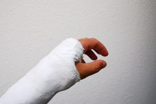 Plaster hand on the left