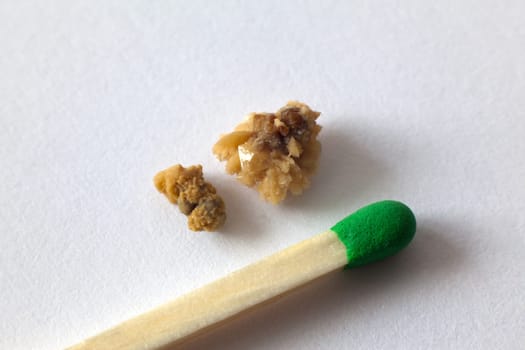 Kidney stones compared to match on macro shot