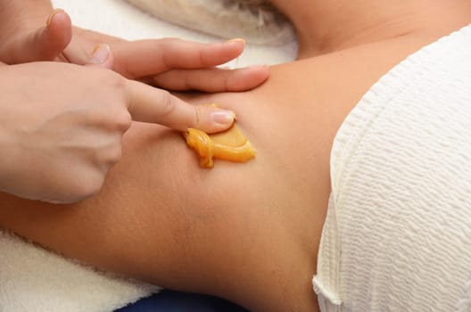 Sugaring: epilation with liquate sugar at armpit.