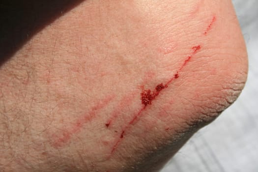 Wound