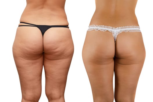 Closeup of cellulite skin at woman buttocks on a white