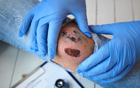 The doctor examines the healing wound of the patient on the leg of the knee torn jeans scarring