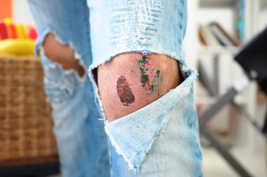 Wound on the knee torn jeans pants doctor