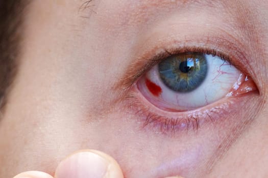 Bloodshot eye. Man, a very red, bleeding eyeball. Bleeding eye injury. Selective focus