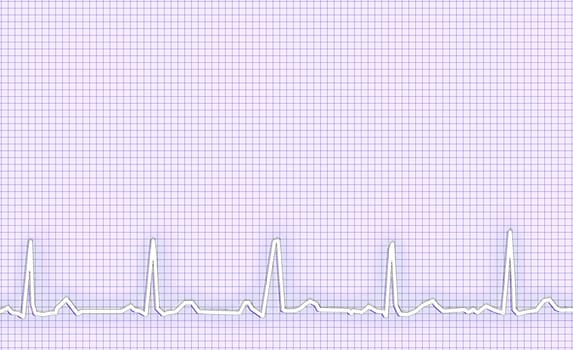 ECG Electrocardiogram