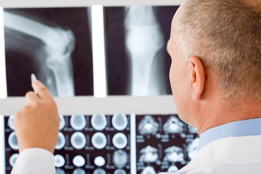 Professional male senior doctor pointing at set of x-rays