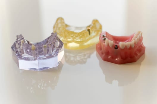 Dental models with dental implants