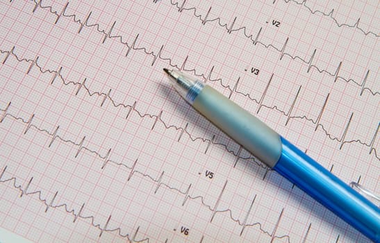 electrocardiogram