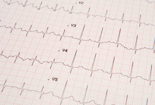 electrocardiogram