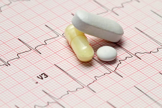 electrocardiogram