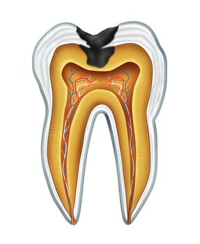 Tooth cavites symbol showing the medical cross section anatomy of teeth with a cavity in decay due to poor bacteria and acids in oral health care and lack of brushing and flosing and visiting the dentist for oral disease prevention.