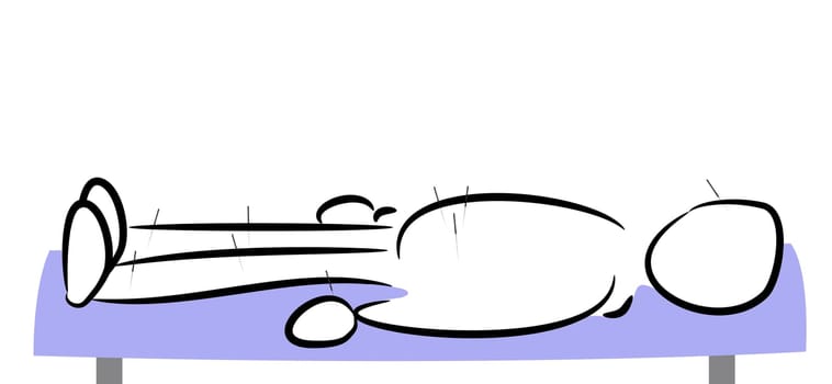 Acupuncture