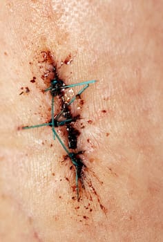 Stitches on human skin with dried blood - macro detail