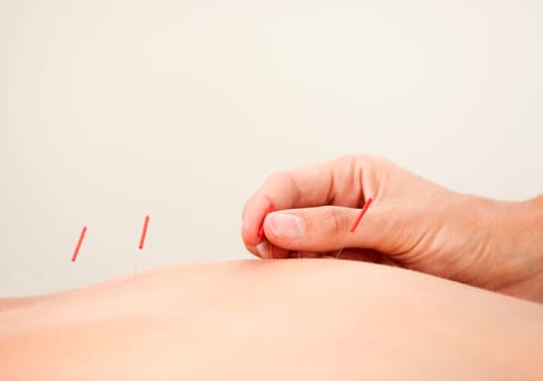 Macro detail of a hand stimulating acupuncture needles along the back