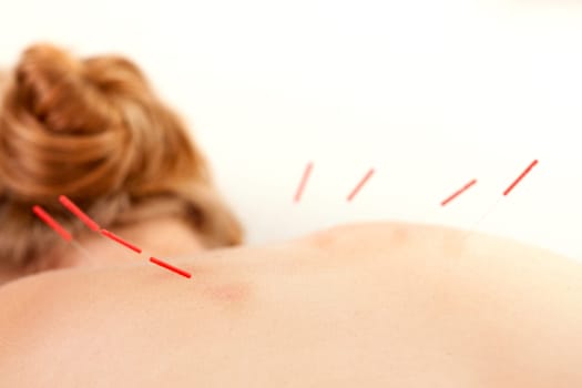 Detail of acupuncture needles inserted in the first Urinary Bladder Channel Line (Shu Points).