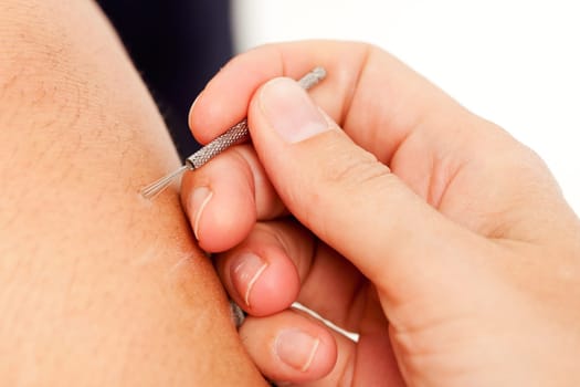 Macro detail of a shonishin acupuncture brush being used on a young boy's leg