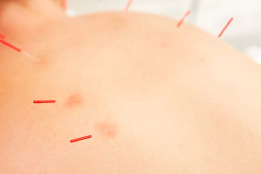 Detail of acupuncture needles inserted in the first Urinary Bladder Channel Line (Shu Points).  Redness around needles points shows good responsivness to treatment