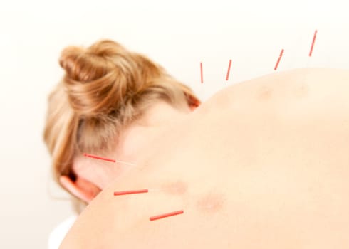 Female acupuncture patient showing good redness at the needle points, a sign of good response to the treatment