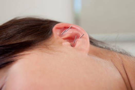 Female patient with acupuncture needles in ears, a cure for smoking addiction