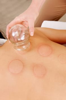 Back detail of a young woman who just underwent an acupuncture fire cupping treatment