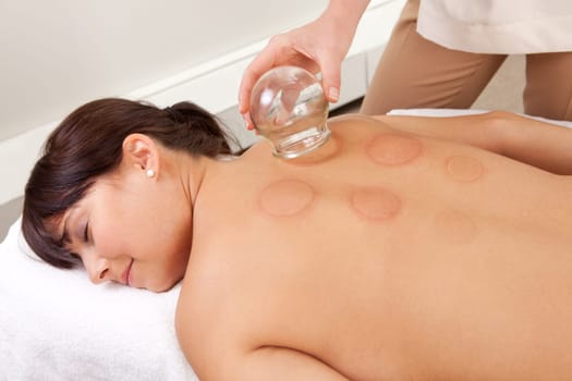 Back detail of a young woman who just underwent an acupuncture fire cupping treatment