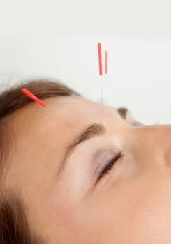 Macro detail of three needles in face of patient