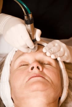 older woman getting electrolysis on he face