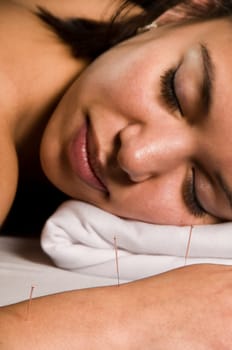 Woman getting an acupuncture treatment in a spa