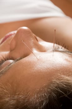 Woman getting an acupuncture treatment in a spa
