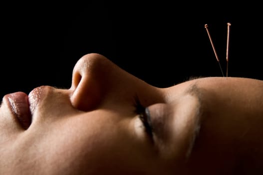 Woman getting an acupuncture treatment in a spa