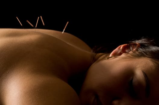 Woman getting an acupuncture treatment in a spa