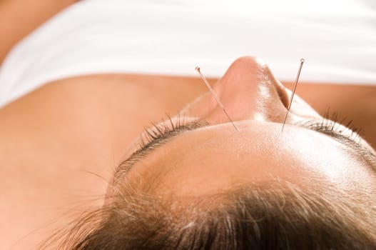 Woman getting an acupuncture treatment in a spa