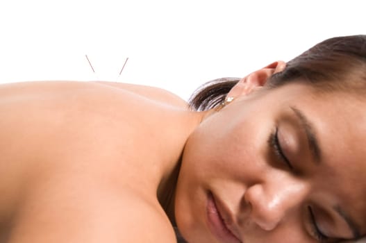 Woman getting an acupuncture treatment in a spa