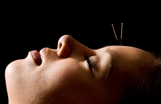 Woman getting an acupuncture treatment in a spa