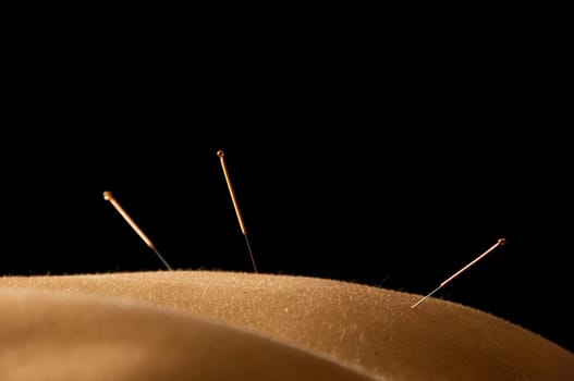 Woman getting an acupuncture treatment in a spa