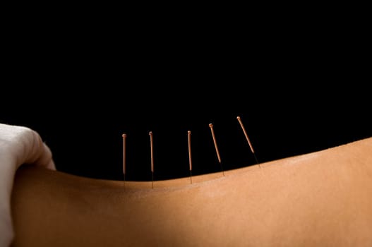 Woman getting an acupuncture treatment in a spa