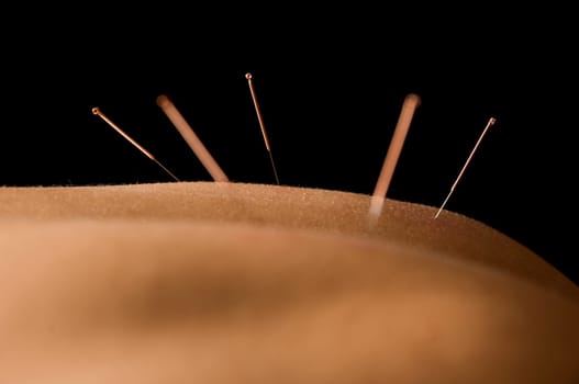 Woman getting an acupuncture treatment in a spa