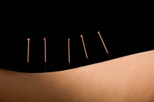 Woman getting an acupuncture treatment in a spa