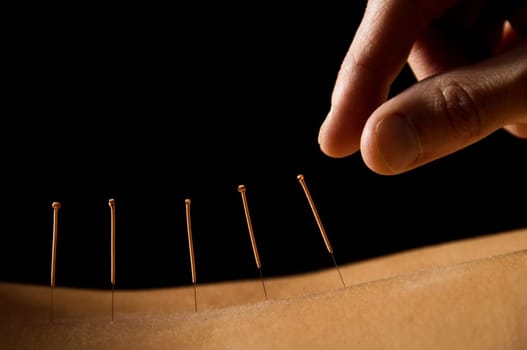 Woman getting an acupuncture treatment in a spa