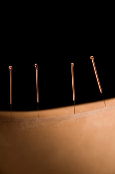 Woman getting an acupuncture treatment in a spa