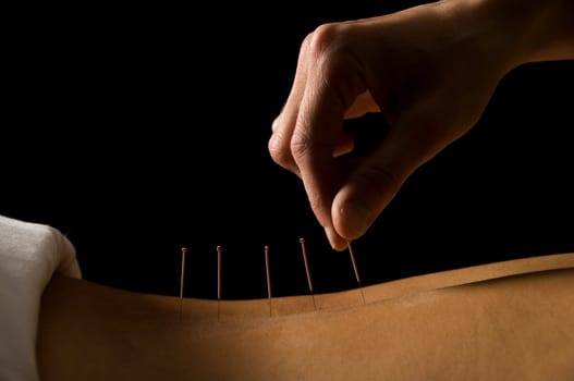 Woman getting an acupuncture treatment in a spa