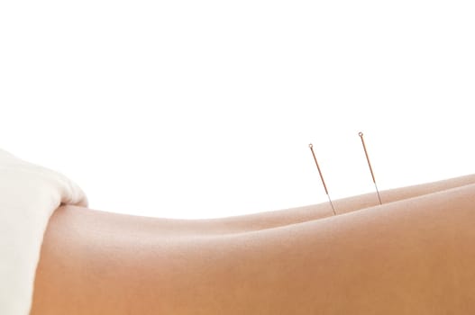 Woman getting an acupuncture treatment in a spa