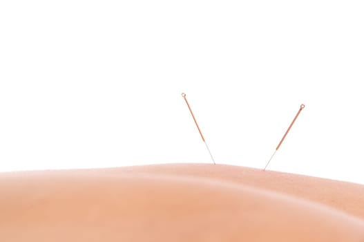 Woman getting an acupuncture treatment in a spa