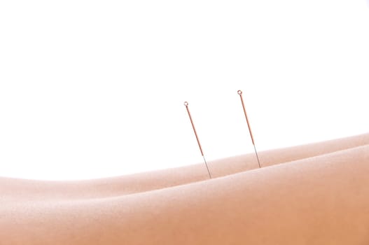 Woman getting an acupuncture treatment in a spa