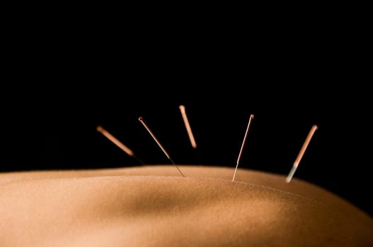 Woman getting an acupuncture treatment in a spa