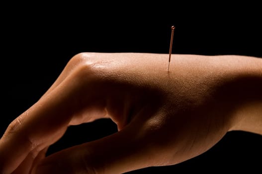 Woman getting an acupuncture treatment in a spa