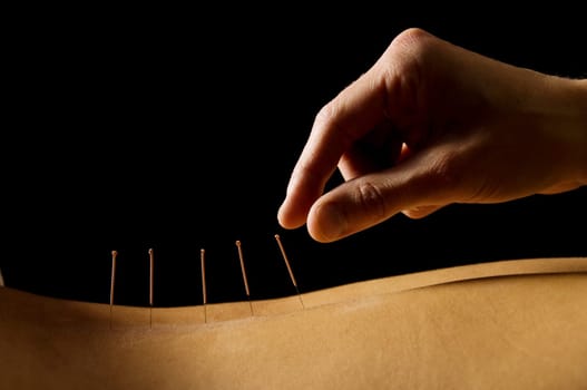 Woman getting an acupuncture treatment in a spa