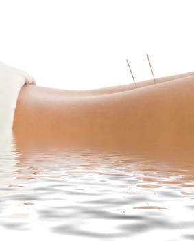 Woman getting an acupuncture treatment in a spa
