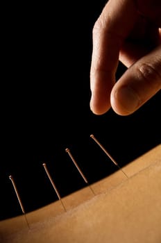 Woman getting an acupuncture treatment in a spa